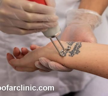 مرکز پاک کردن تتو در گوهردشت کرج