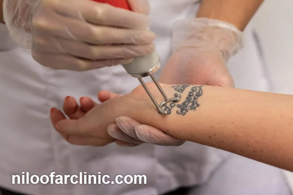 مرکز پاک کردن تتو در گوهردشت کرج