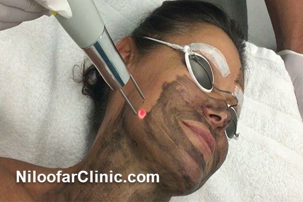 لیزر کربن تراپی چیست و چگونه عمل میکند؟