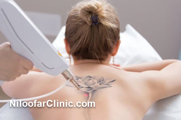 پاک کردن تتو چیست و چگونه انجام میشود؟