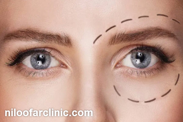 کاربردهای تزریق فیلر زیر چشم