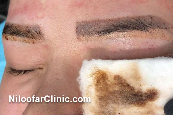 مزایای پاک کردن تاتو ابرو در کلینیک نیلوفر