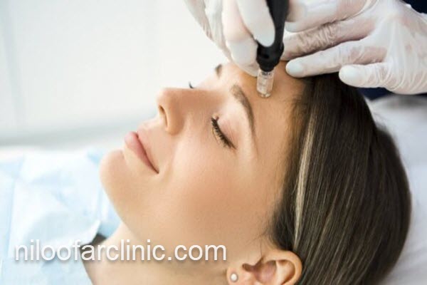 انجام مزونیدلینگ در کلینیک معتبر کرج | نیلوفر کلینیک