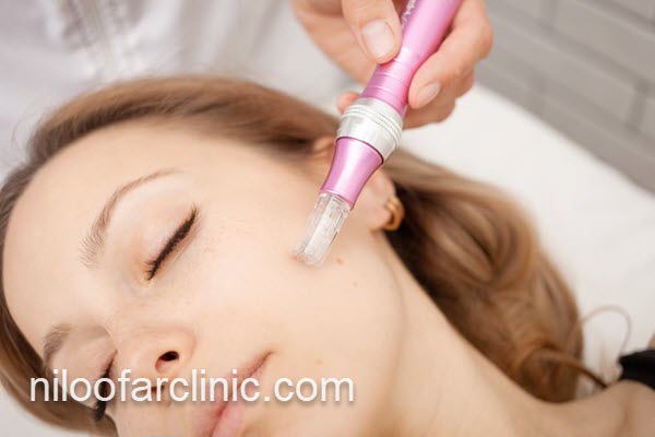 میکرونیدلینگ صورت با کمترین درد در البرز | نیلوفر کلینیک